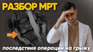 Неприятные последствия после удаления грыжи L5-S1. Разбор МРТ после операции