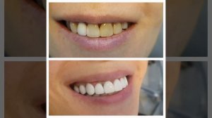 Композитные виниры - протезирование выполнено врачом Габараева Н.В.