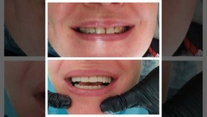 Композитные виниры - протезирование выполнено врачом Габараева Н.В.