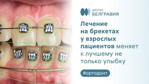 У взрослых пациентов лечение на брекетах меняет к лучшему не только улыбку