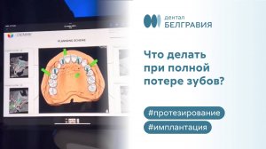 Что делать при полной потере зубов? Решение от команды врачей Belgravia Dental Studio