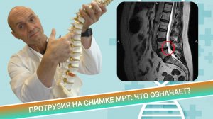 ЧТО НА САМОМ ДЕЛЕ ОЗНАЧАЕТ ПРОТРУЗИЯ В МРТ ПОЗВОНОЧНИКА?