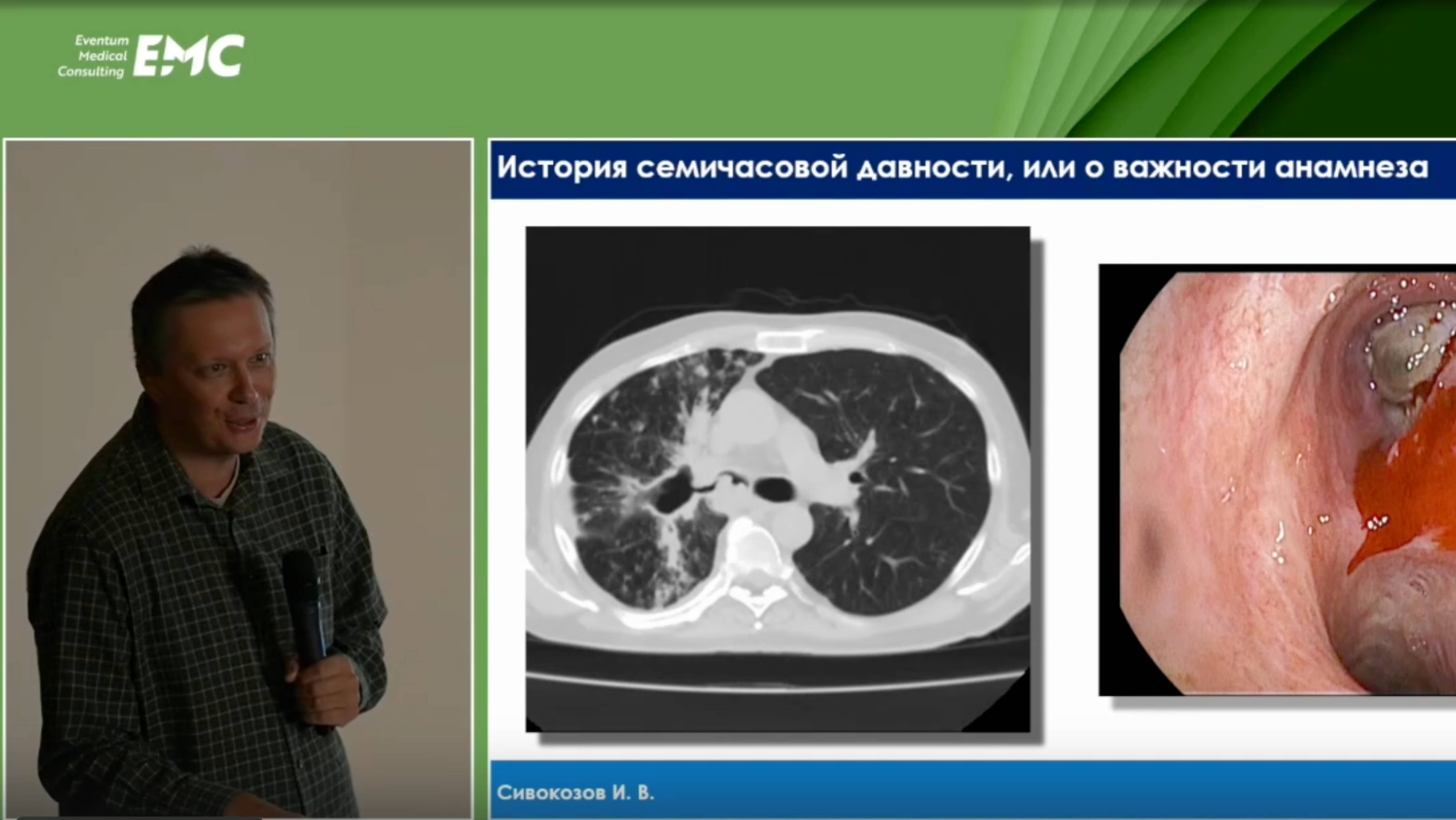 2. Сивокозов И.В. Новинки эндоскопической биопсии средостения: истории "в лицах".