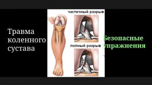 Безопасные и полезные упражнения при травме коленного сустава
