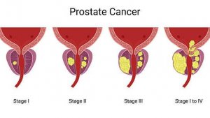 Рак простаты НЕ ПРИГОВОР! Просто обрати внимание на ЭТИ СИМПТОМЫ