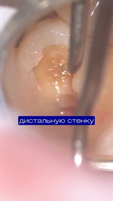 Кариес везде! Как лечат зубы с глубоким кариесом за два приема? #стоматология #кариес  #терапевт