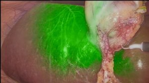 Холецистэктомия в режиме ICG на Видеокамере EndoGlance®️ V ICG AF 01.11.2025