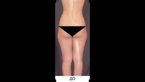 РУЧНАЯ ПЛАСТИКА ТЕЛА NEWBODYKA. КОРРЕКЦИЯ ФИГУРЫ. КАЛИНИН АЛЕКСЕЙ. РЕЗУЛЬТАТ ДО И ПОСЛЕ. ВИДЕО 4(1)