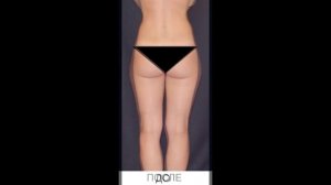 РУЧНАЯ ПЛАСТИКА ТЕЛА NEWBODYKA. КОРРЕКЦИЯ ФИГУРЫ. КАЛИНИН АЛЕКСЕЙ. РЕЗУЛЬТАТ ДО И ПОСЛЕ. ВИДЕО 1(1).