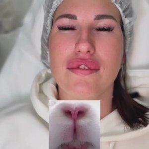 У девушек новый шизотренд — эффект «заячьих губок»: филер в губу (только верхнюю) 🫣😱🤮