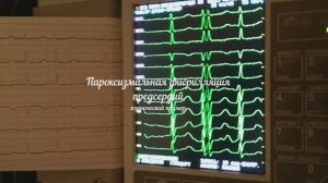 фибрилляция предсердий. (мерцательная аритмия) пароксизм