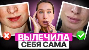 Как я спасла своё лицо? МОЯ ИСТОРИЯ лечения дерматита и анке БЕЗ косметологов и врачей