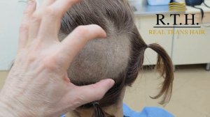 клинический случай работы с андрогенетической алопецией у женщины!
