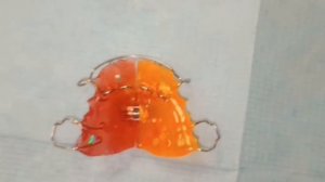 Аппарат с заслоном для языка, для устранения инфантильного глотания, прокладывания языка.