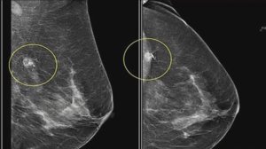 Жительницы Алтайского края бесплатно прошли маммографию в Барнауле