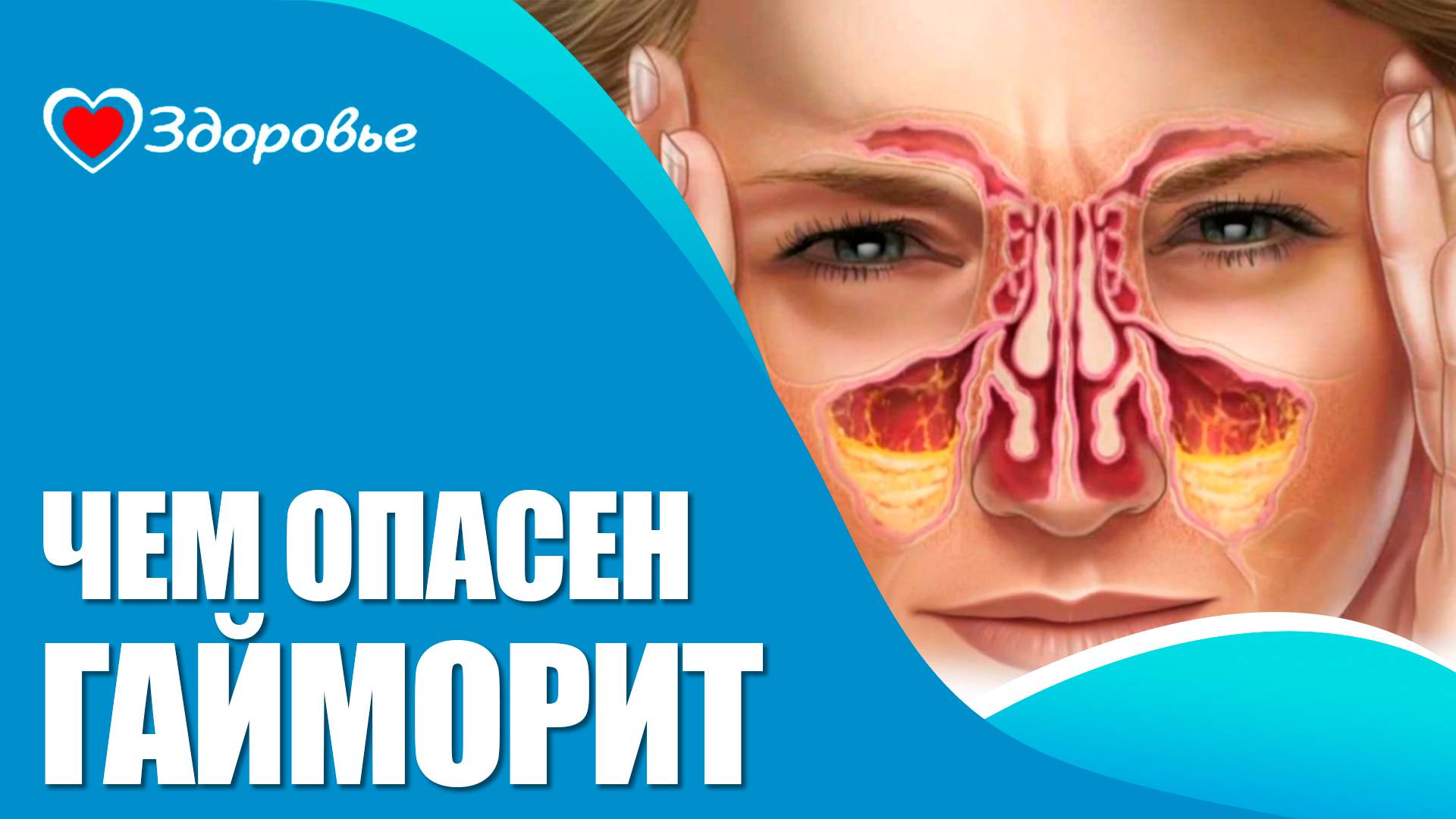 Гайморит. Здоровье
