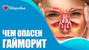 Гайморит. Здоровье