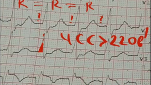 WPW СИНДРОМ смотреть онлайн