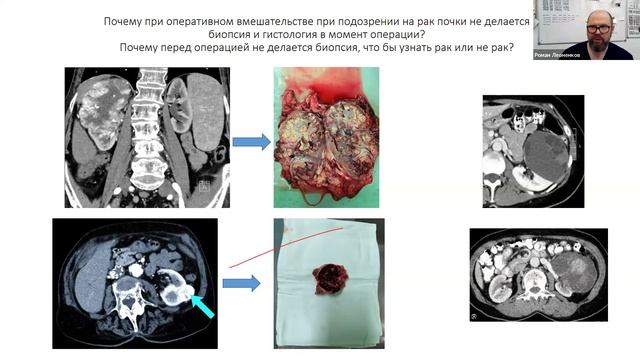 Хирургическое лечение рака почки. Ответы на вопросы (Леоненков Р.В.) смотреть онлайн