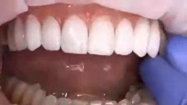 ПРОЦЕСС ФИКСАЦИИ