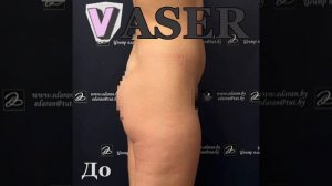 Ультразвуковая VASER-липосакция талии и живота. липофилинг ягодиц