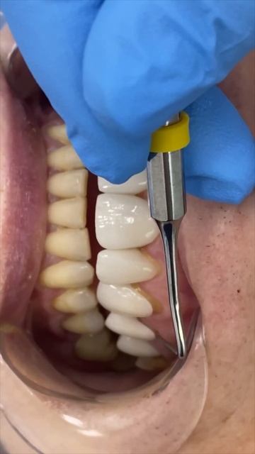 Минимальная толщина препарирования для виниров  #винирыназубы