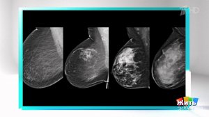 Анализ риска рака груди: что делать дальше? Фрагмент выпуска от 07.11.2025