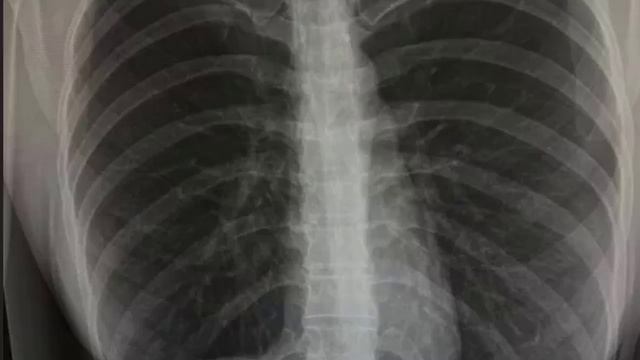 💕 Яна Захарова сделала блефаропластику| Новости Дом 2 смотреть онлайн