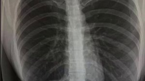 💕 Яна Захарова сделала блефаропластику| Новости Дом 2