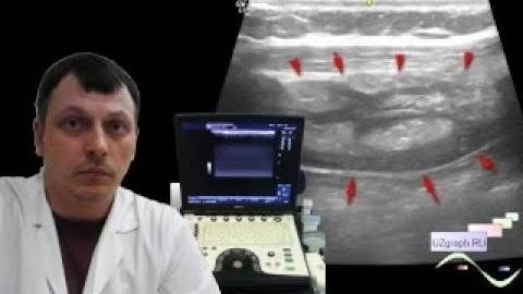 Детское УЗИ мягких тканей - Утолщение и неоднородность мягких тканей межреберного промежутка смотреть онлайн