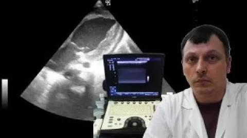 Детская Эхокардиография - Аортальный стеноз смотреть онлайн