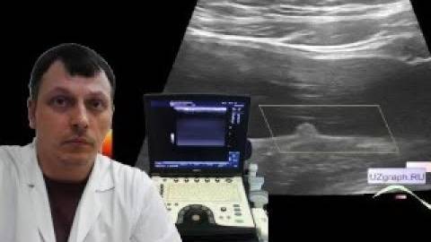 Детское УЗИ мочевого пузыря - Пристеночное образование мочевого пузыря смотреть онлайн