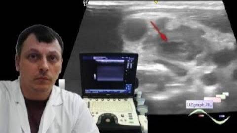 Детское УЗИ мягких тканей - Гнойный лимфаденит смотреть онлайн