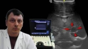 Детская НСГ - Киста в проекции рядом с задним рогом бокового желудочка