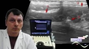 Детское УЗИ брюшной полости - Илеотифлит и мезаденит