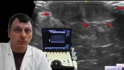 Детское УЗИ мягких тканей - Кожное образование в проекции хирургического шва смотреть онлайн