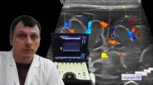 Детская нейросонография - Субдуральное скопление