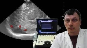 Детская Нейросонография - Анэхогенное включение в задней черепной ямке