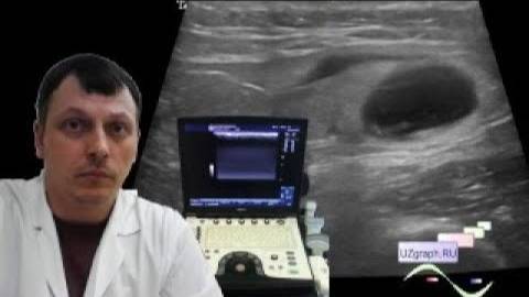 Детское УЗИ мягких тканей - Гематома ягодичной области смотреть онлайн