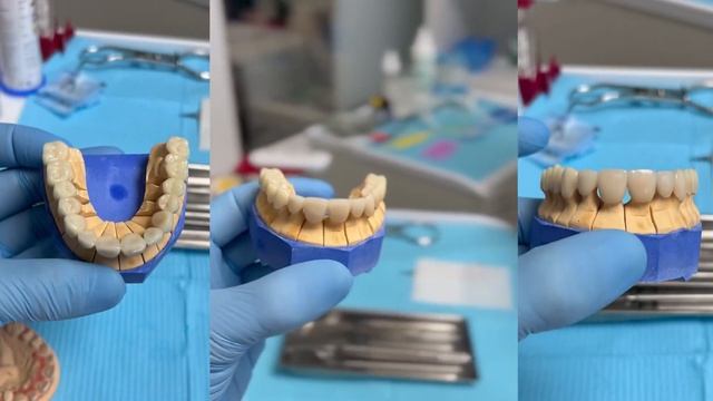 КАК ПРОВЕРИТЬ ВРАЧА ПЕРЕД УСТАНОВКОЙ ВИНИРОВ? смотреть онлайн