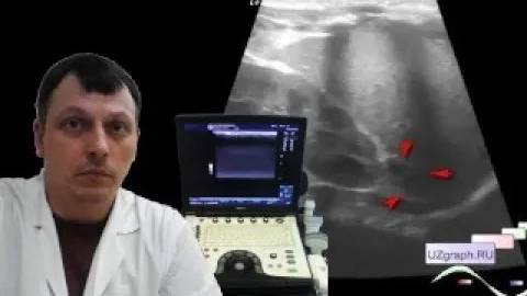 Детское УЗИ почек и надпочечников - Образования в проекции надпочечников смотреть онлайн