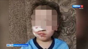 В Яранском районе 7-летнему ребенку заплатили компенсацию за травму, причиненную собакой