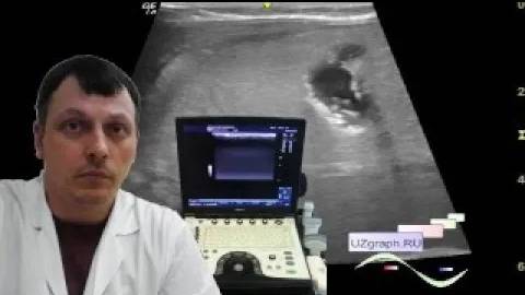 Детское УЗИ брюшной полости - Холелитиаз и гиперэхогенная стенка желчного пузыря смотреть онлайн