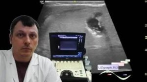 Детское УЗИ брюшной полости - Холелитиаз и гиперэхогенная стенка желчного пузыря