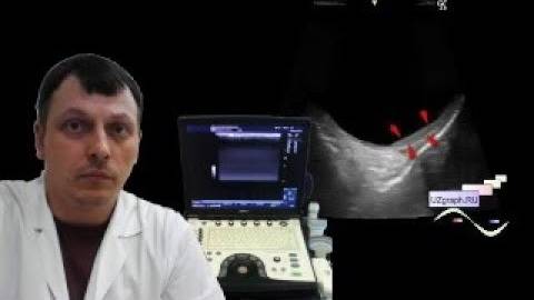 Детское УЗИ мошонки - Старая водянка, изменения яичка смотреть онлайн