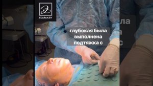 Композитная подтяжка лица