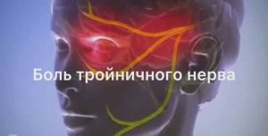 Невралгия тройничного нерва