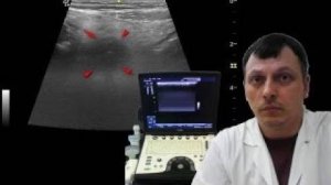 Детское УЗИ брюшной полости - Острый аппендицит, периаппендикулярный инфильтрат