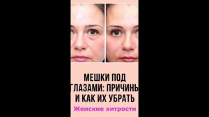Народная медицина. Отечность под глазами исчезнет через пять минут.