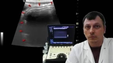 Детское УЗИ брюшной полости (кишечника) - Мегаколон смотреть онлайн